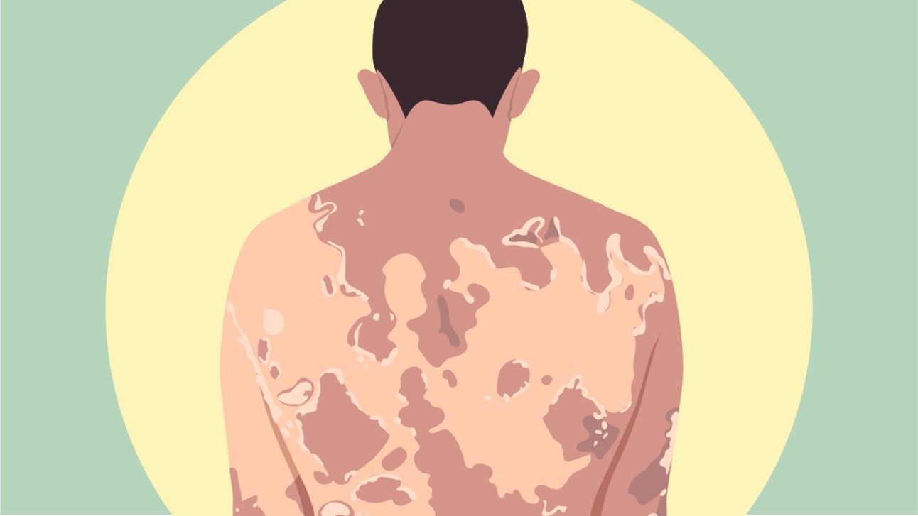 An illustration of how Netherton Syndrome (NS) can affect the skin of people living with the condition. 